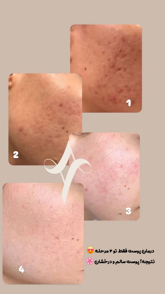 خدمات پاکسازی و درمان پوست یلدا اکبری در شیراز